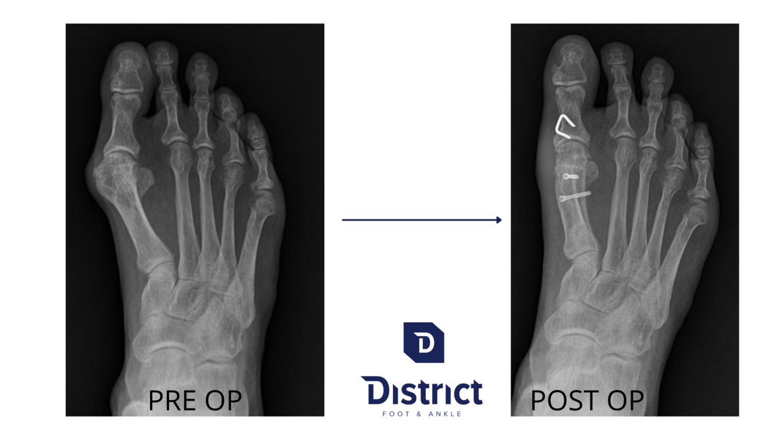 Foot Bunion Treatment Surgery Doctor Alexandria, Northern VA