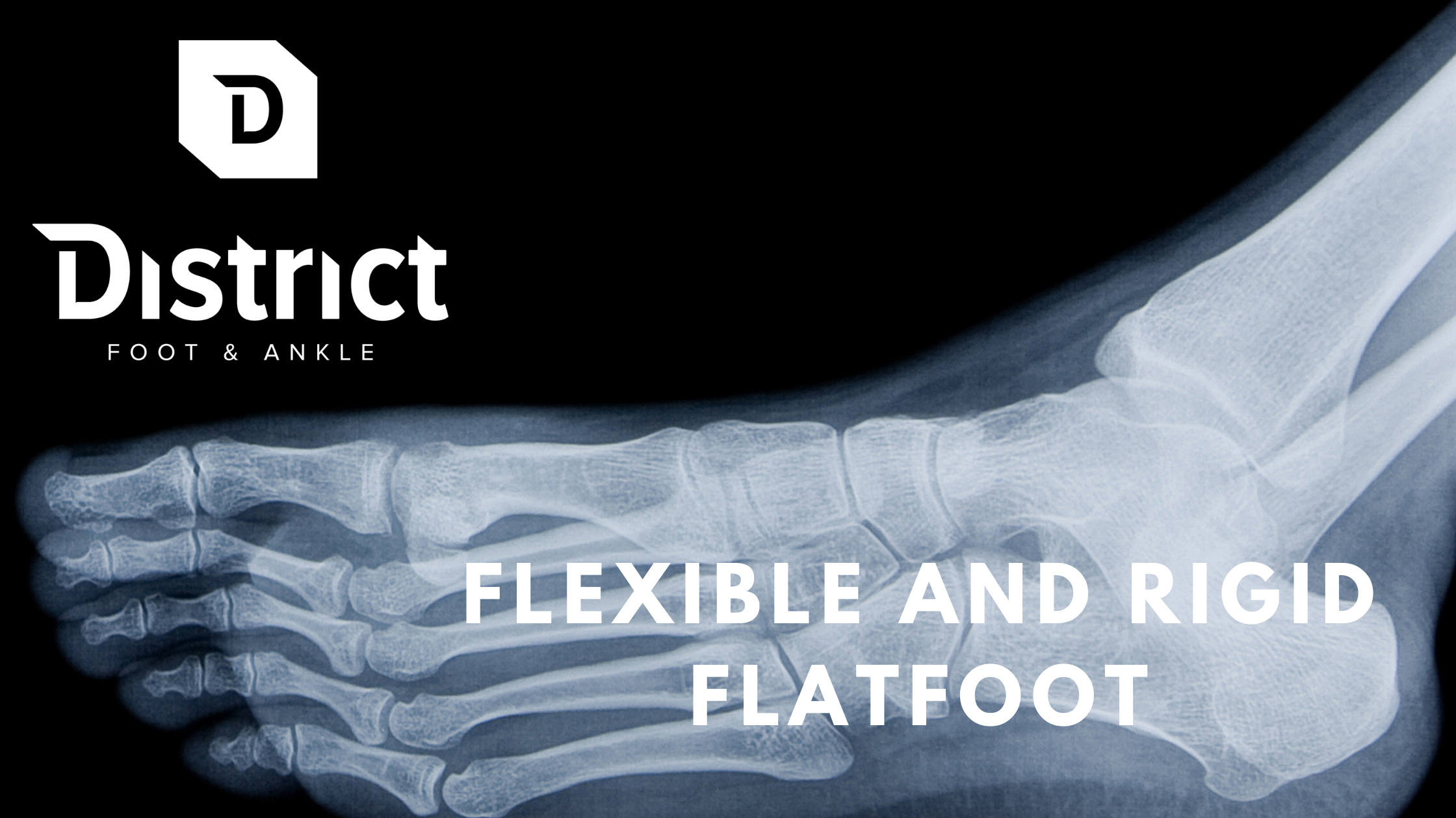 flexible or rigid flatfoot deformity