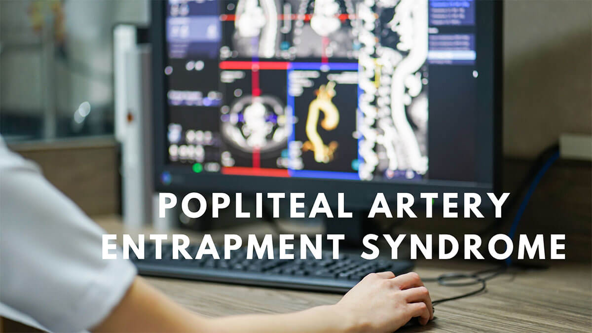 Popliteal-Artery-Entrapment-Syndrome