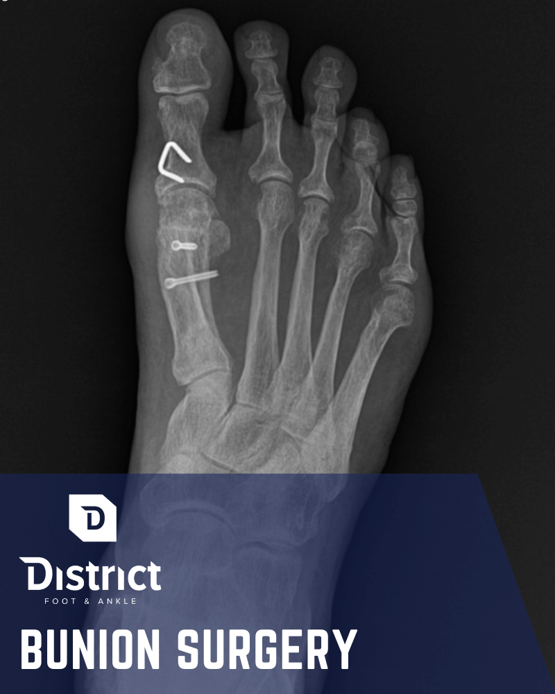 Bunion-Surgery-Featured