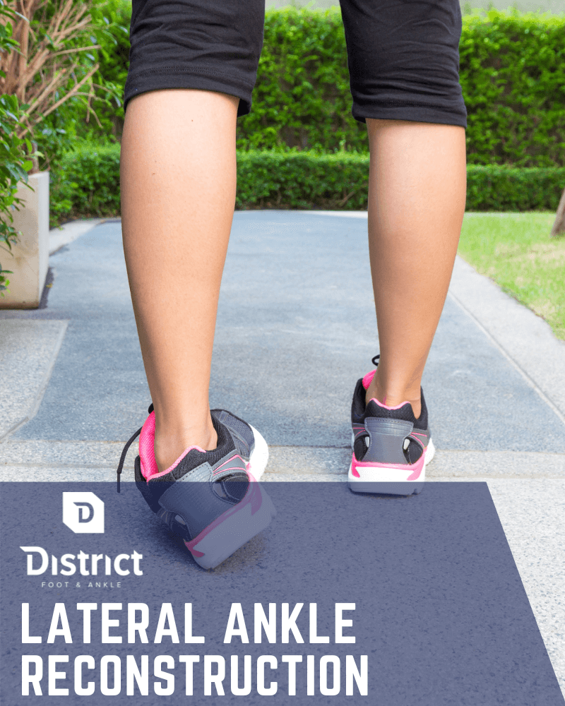 Lateral-Ankle-Reconstruction-Featured