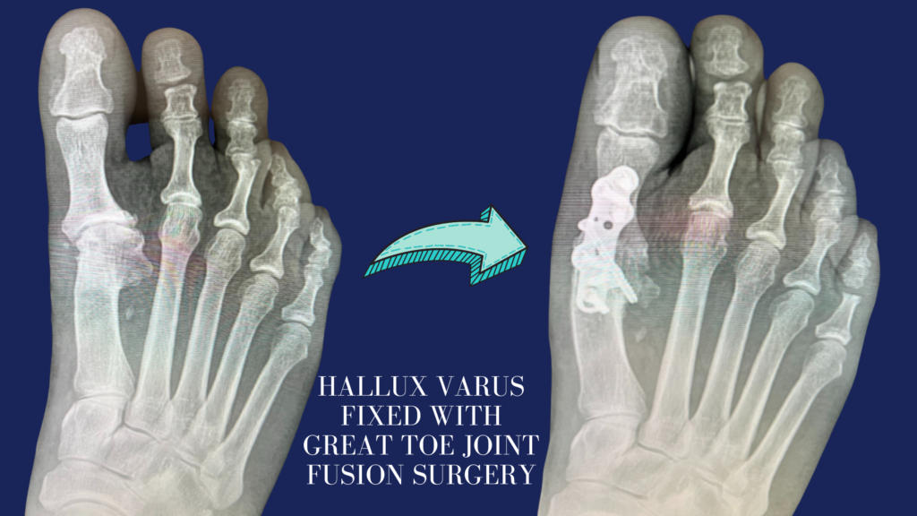 Hallux Varus Deformity