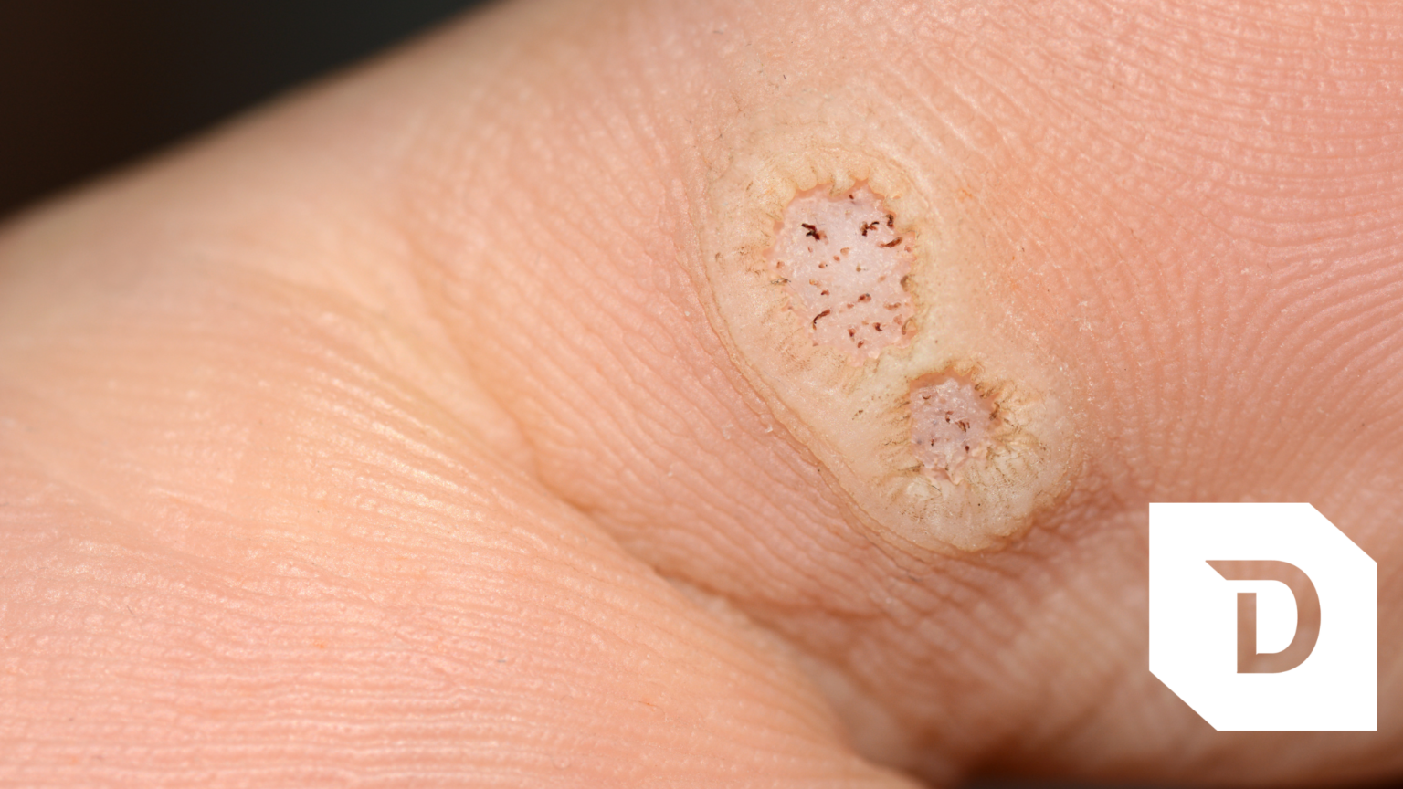 Swift Microwave Therapy — The Best Treatment For Plantar Warts